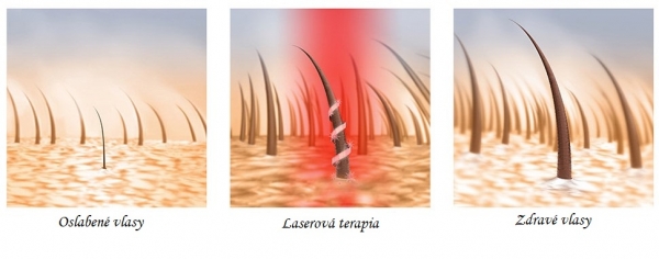 Laserový hrebeň / liečba alopécie